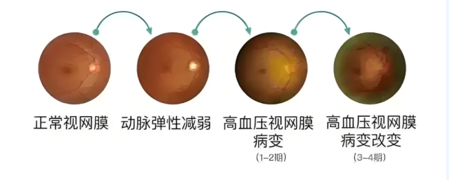 視網膜中央動脈阻塞